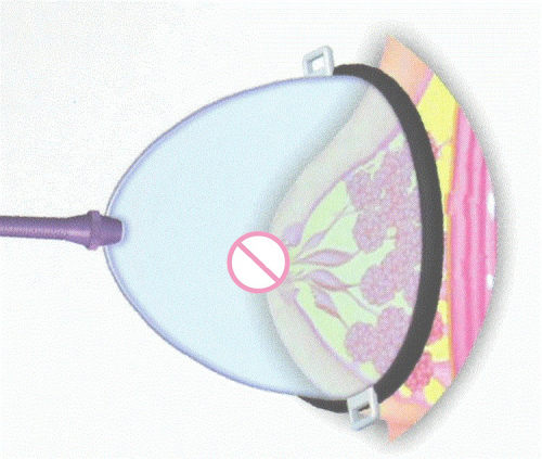 Вакуумный насос для увеличения груди 105*100 мм, 110*130 мм photo 1